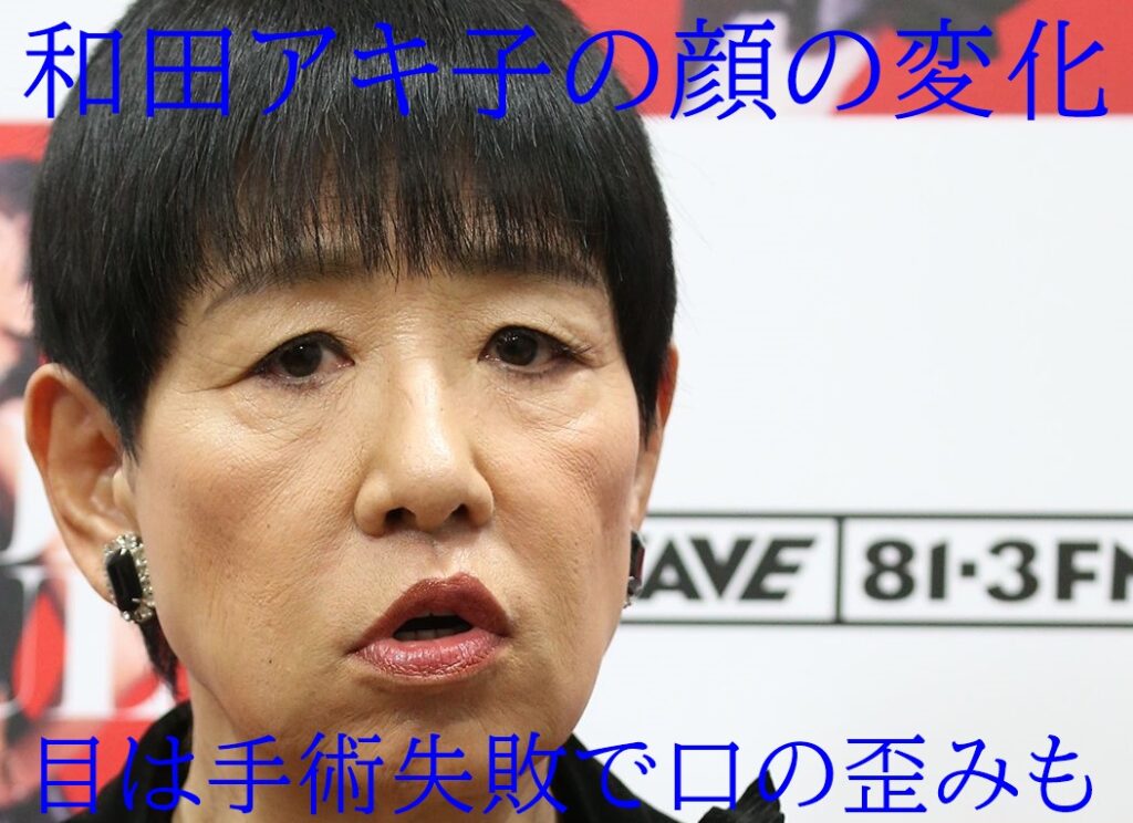 画像 和田アキ子が顔面崩壊 目は手術失敗で口の歪みは病気が原因
